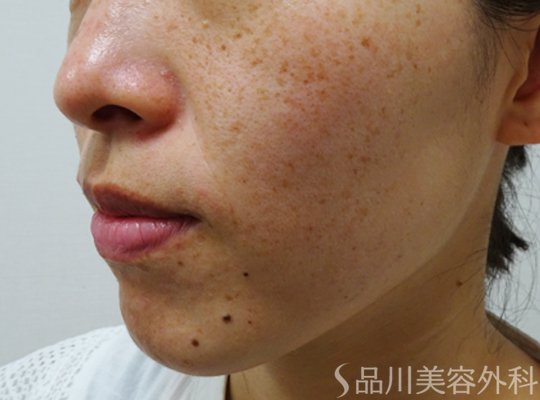 症例NO.75186のBEFORE写真