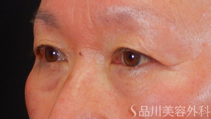 症例NO.69584のBEFORE写真