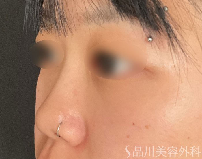 症例NO.75191のBEFORE写真