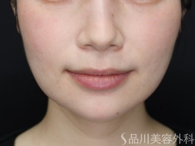 症例NO.69539のAFTER写真