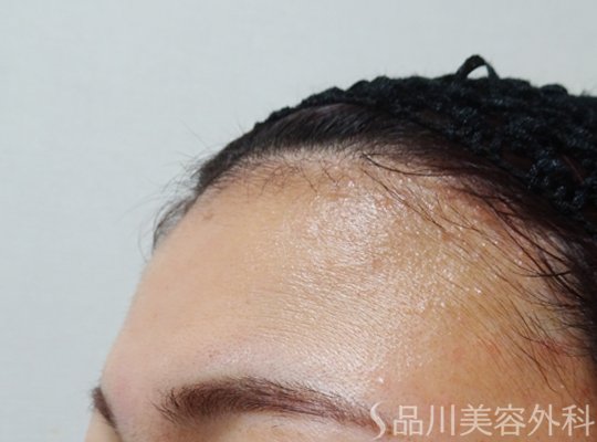 症例NO.67603のBEFORE写真