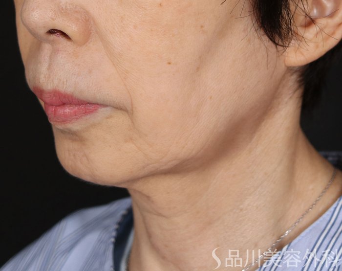 症例NO.71097のBEFORE写真