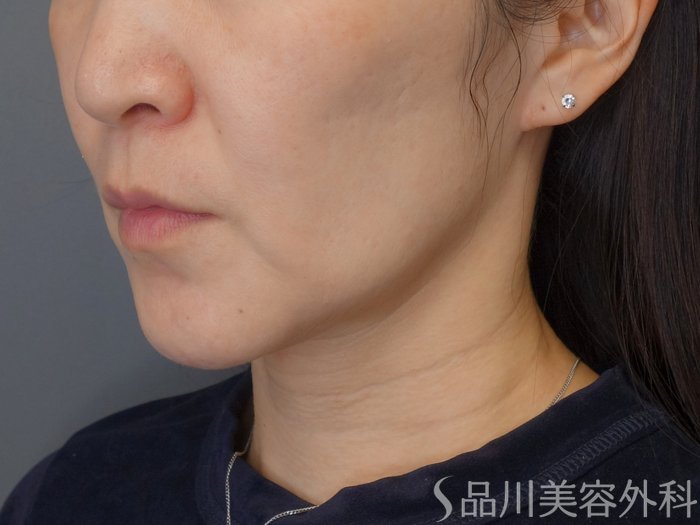 症例NO.72696のBEFORE写真