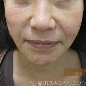 症例NO.71985のAFTER写真