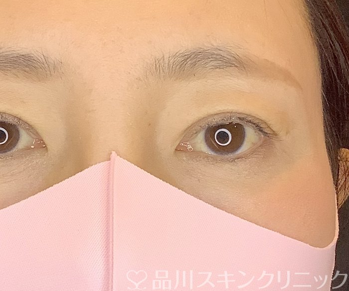 症例NO.65381のAFTER写真