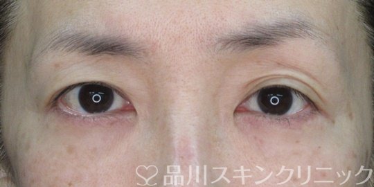症例NO.72677のBEFORE写真