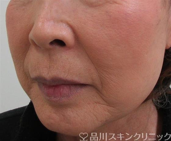 症例NO.33061のBEFORE写真