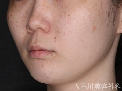 症例NO.72672のBEFORE写真