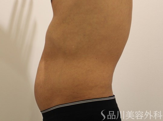 症例NO.62492のBEFORE写真