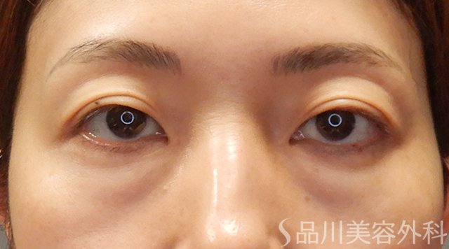 症例NO.73999のBEFORE写真