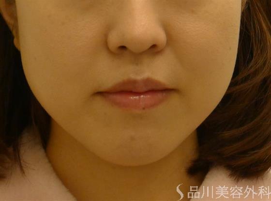 症例NO.34165のAFTER写真