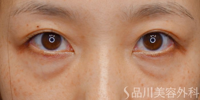 症例NO.73561のBEFORE写真