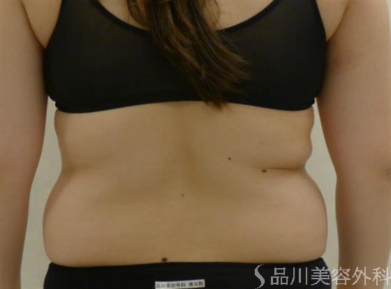 症例NO.35186のBEFORE写真
