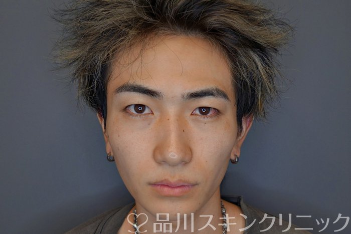 症例NO.73977のBEFORE写真