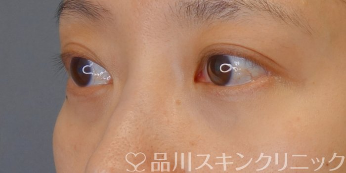 症例NO.74081のAFTER写真