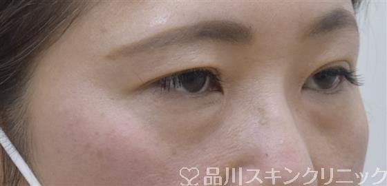症例NO.54325のBEFORE写真