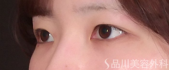 症例NO.70104のBEFORE写真