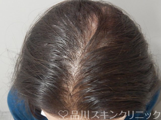 症例NO.68636のAFTER写真