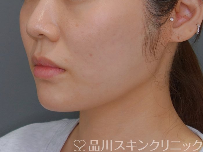 症例NO.73802のBEFORE写真