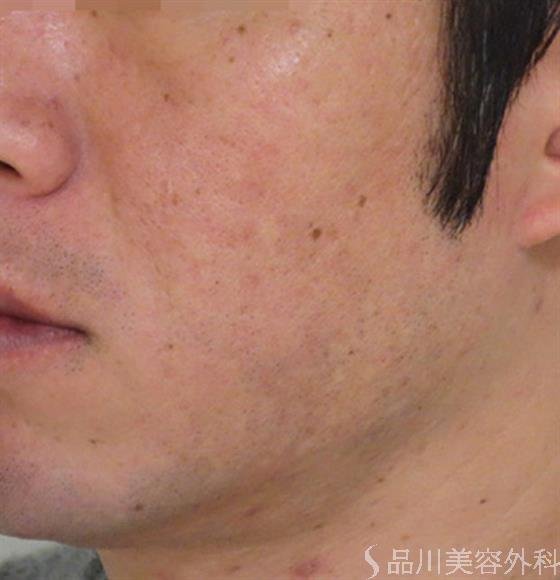 症例NO.47064のAFTER写真