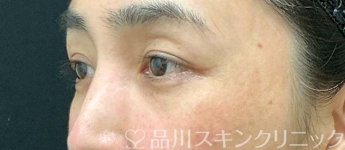 症例NO.75199のBEFORE写真
