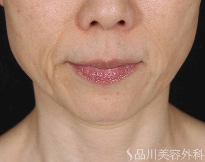 症例NO.71081のBEFORE写真