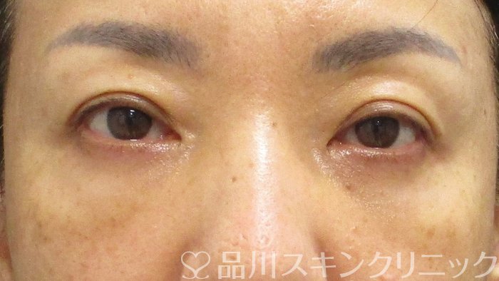 症例NO.73045のAFTER写真