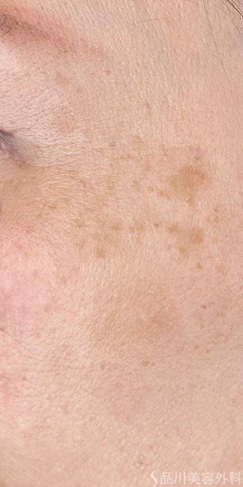 症例NO.72476のAFTER写真