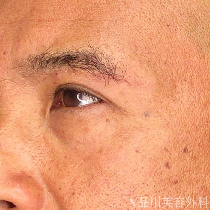 症例NO.71834のAFTER写真