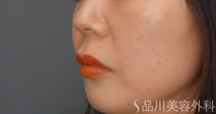 症例NO.65070のBEFORE写真