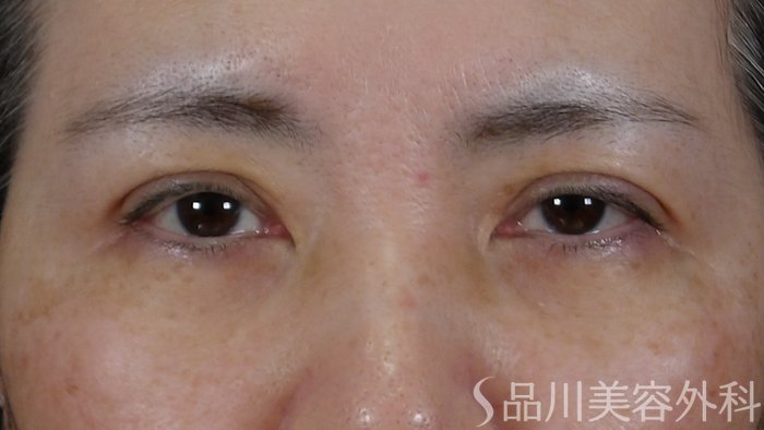 症例NO.70896のAFTER写真