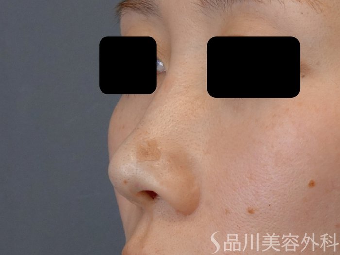 症例NO.72974のAFTER写真