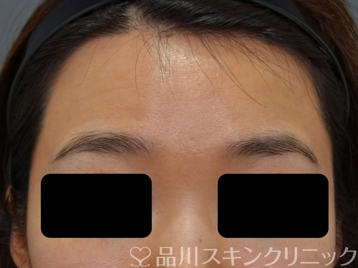 症例NO.73444のBEFORE写真