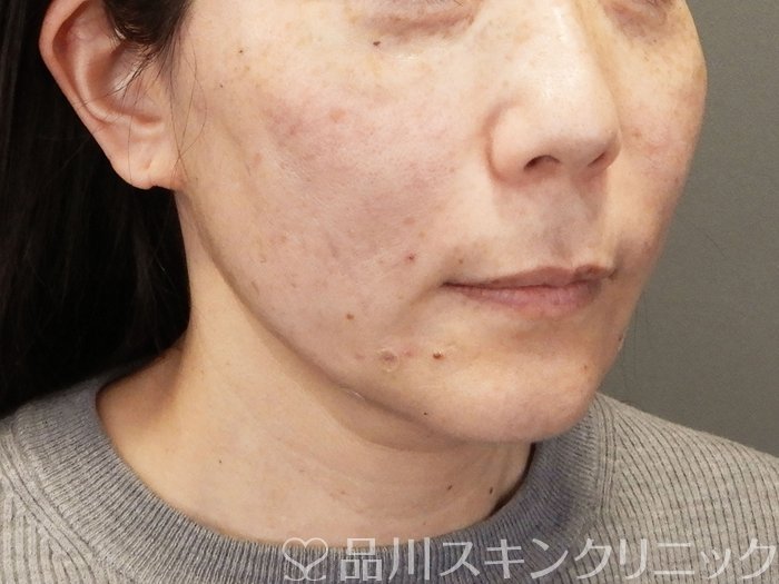 症例NO.70301のAFTER写真