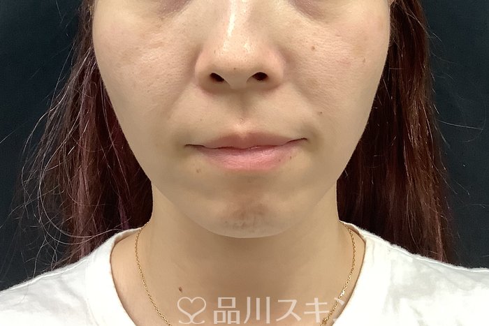 症例NO.69560のBEFORE写真
