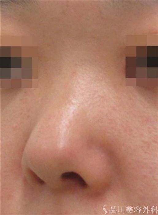 症例NO.23856のBEFORE写真