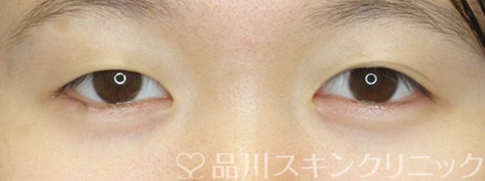 症例NO.69862のBEFORE写真