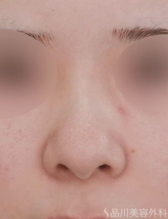 症例NO.62167のBEFORE写真