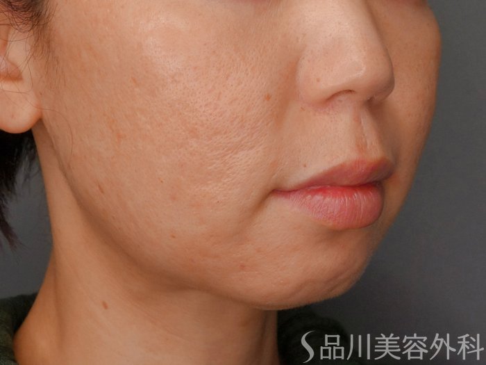 症例NO.73246のBEFORE写真