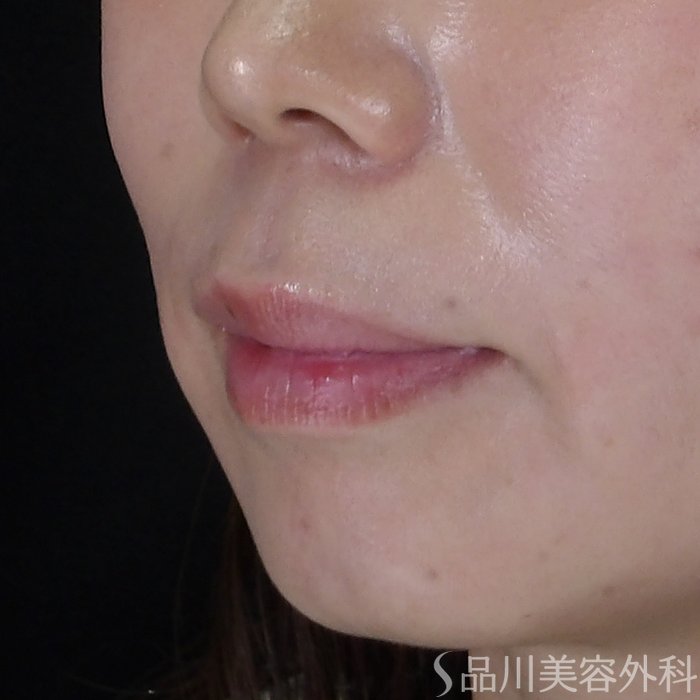 症例NO.71479のBEFORE写真
