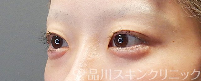 症例NO.72453のAFTER写真