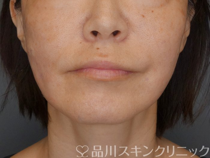 症例NO.71273のAFTER写真