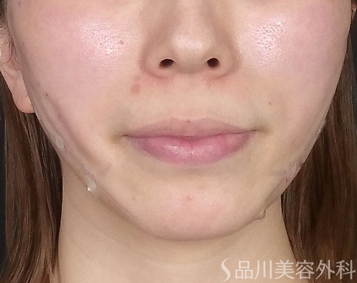 症例NO.65520のAFTER写真