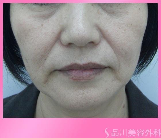 症例NO.3240のBEFORE写真