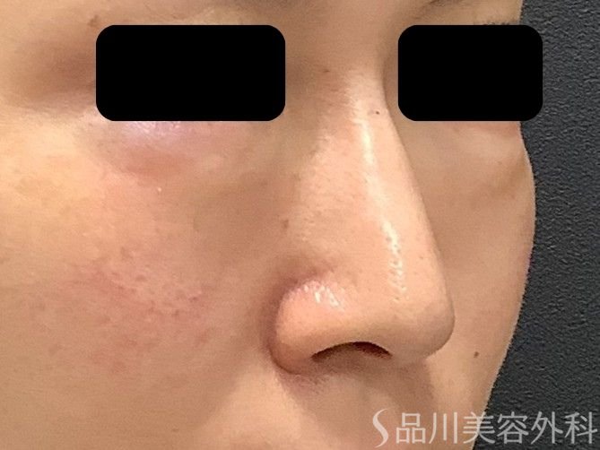 症例NO.75322のAFTER写真