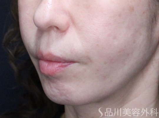 症例NO.73558のAFTER写真