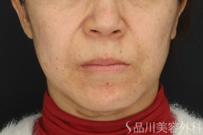 症例NO.73233のAFTER写真