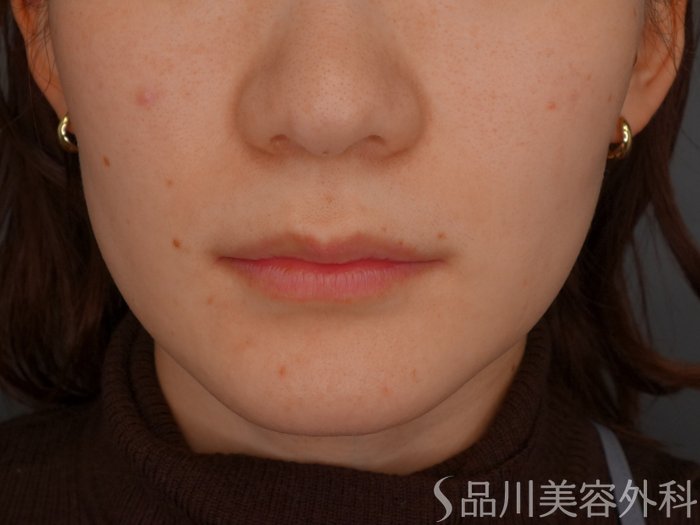 症例NO.73627のBEFORE写真