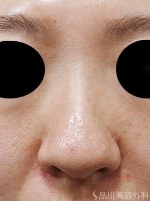 症例NO.75176のBEFORE写真
