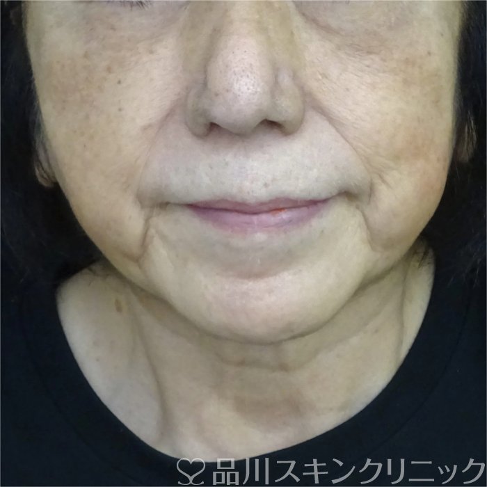 症例NO.72385のAFTER写真